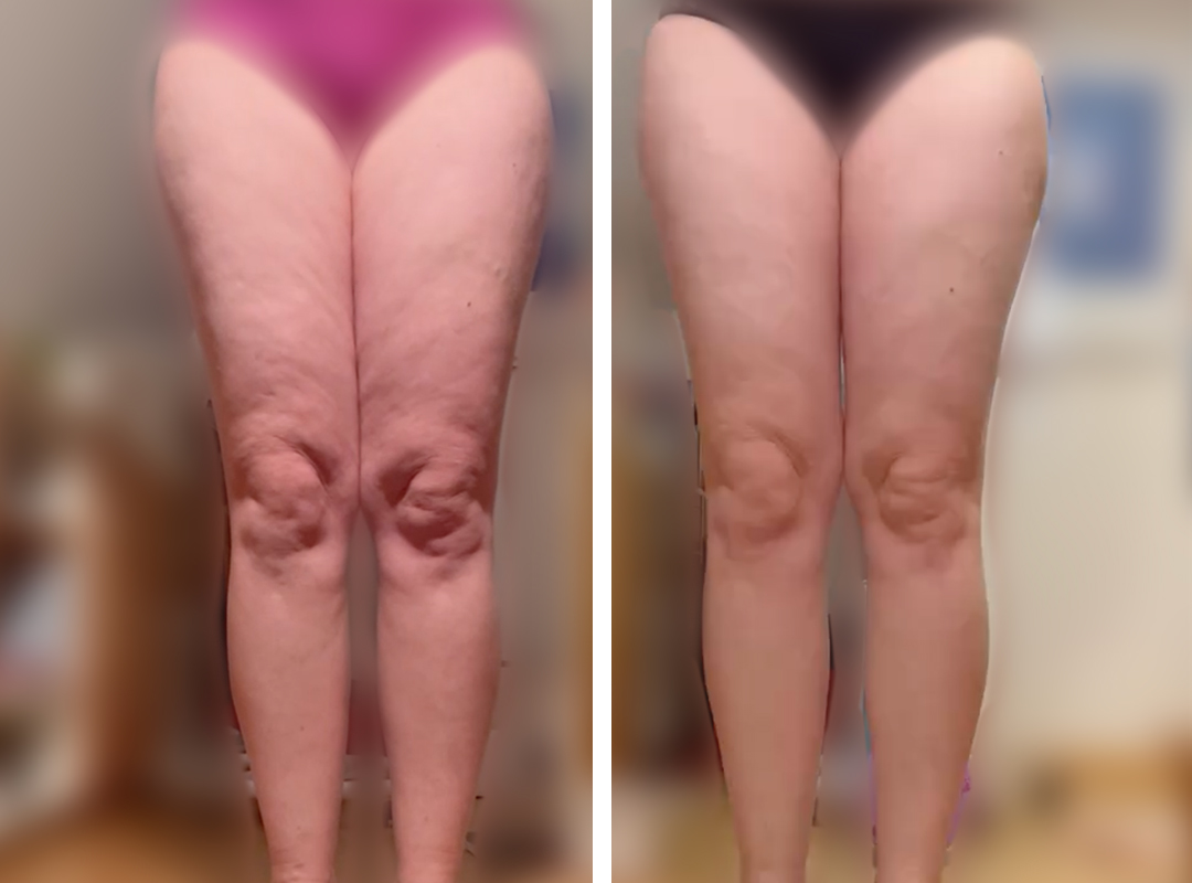 Anjas Vorher-Nachher: Cellulite loswerden, Arme straffen, Besenreiser loswerden